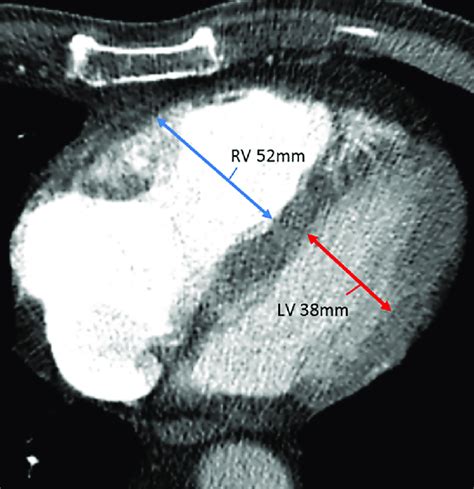 rv lv ratio radiopaedia.